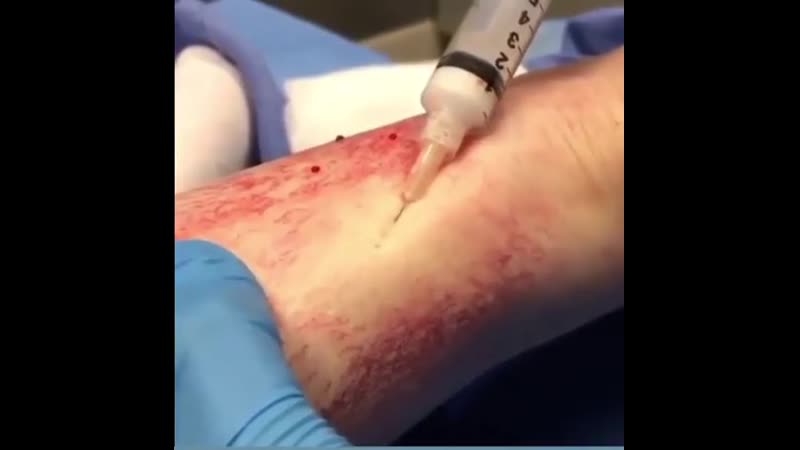 Склеротерапия 💉