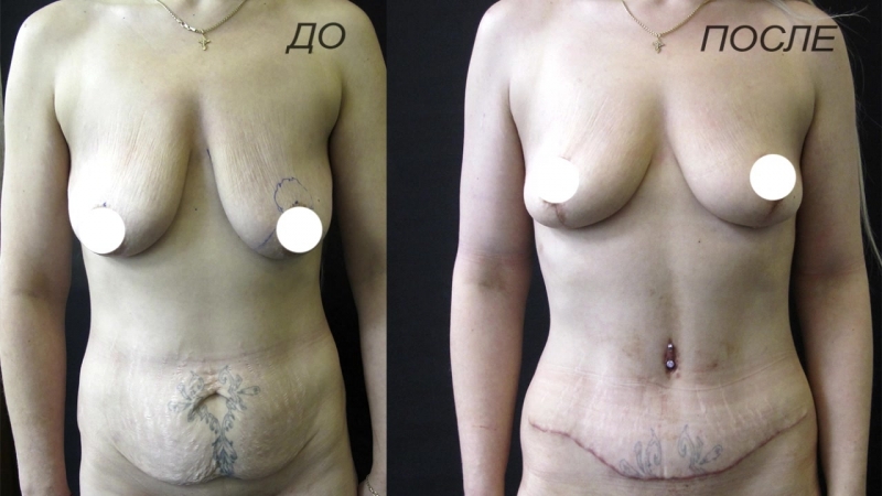 До/после подтяжка молочных желёз + абдоминопластика