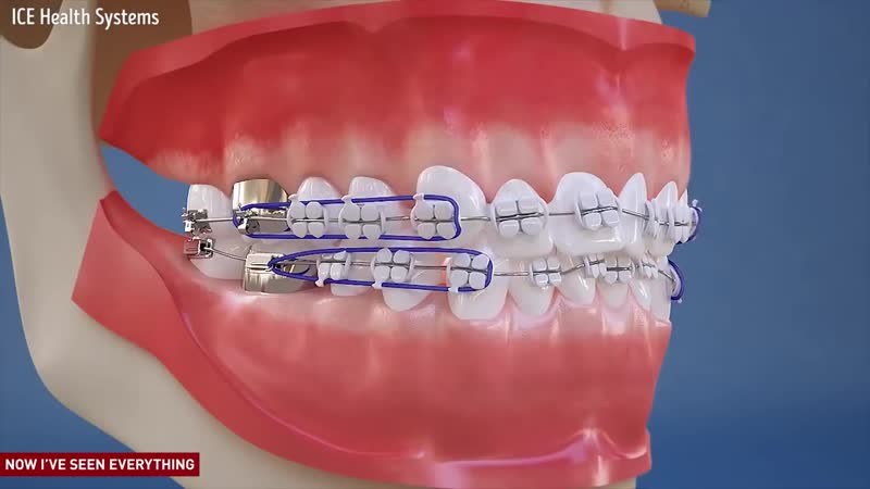 How braces work пропедевтика ортодонтии