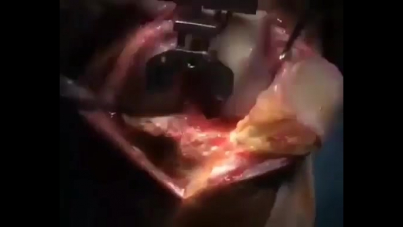 Эндопротезирование коленного сустава