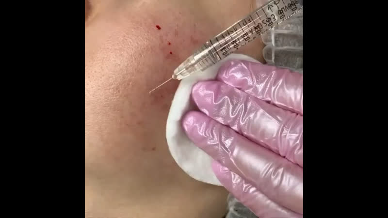 🌾коррекция рубцов постакне🌾