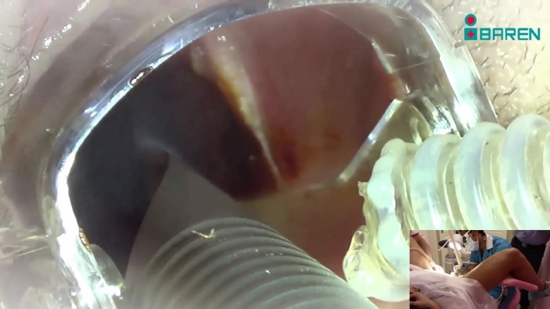 Эктопия шейки матки эрозия