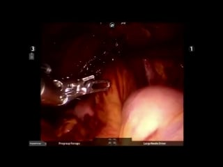 Robotic assisted radical cystectomy with intracorporeal neobladder formation