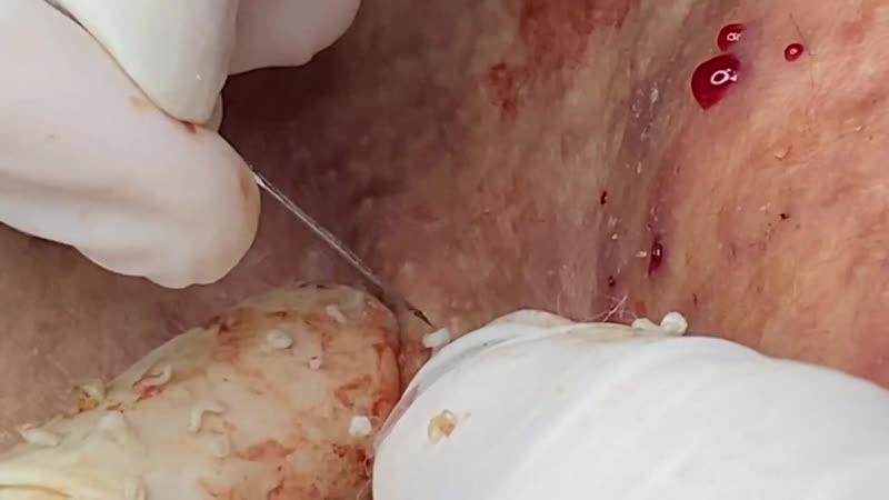 "тысяча выдавливаний" сезон 2, серия 2 из 3