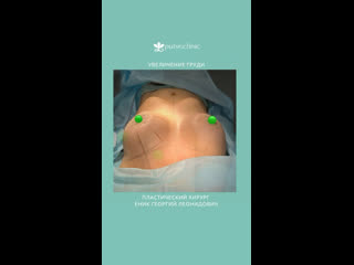 Увеличение груди в клинике пульс архангельск пластический хирург еник георгий леонидович