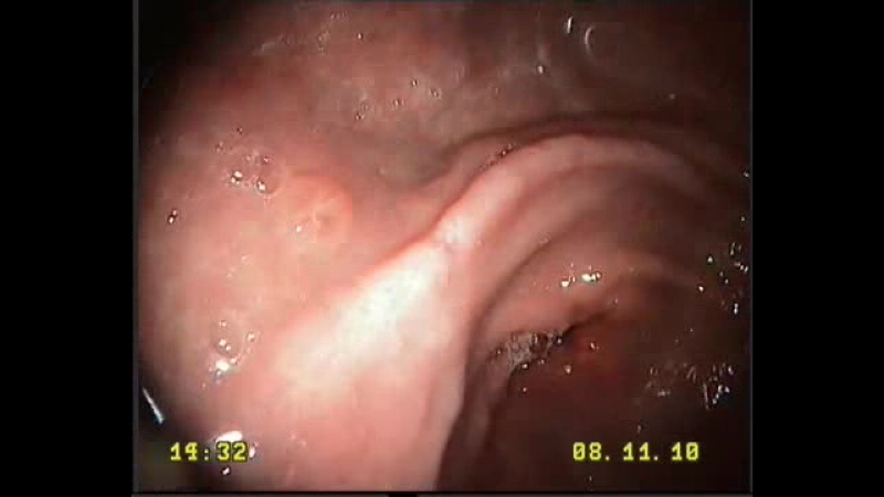 Гастроскопия