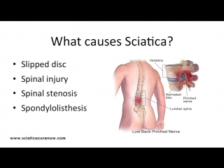 What is sciatica and how is it treated [updated to 2018]