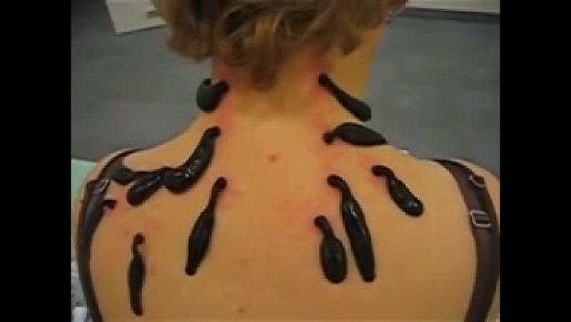 Гирудотерапия лечение пияами