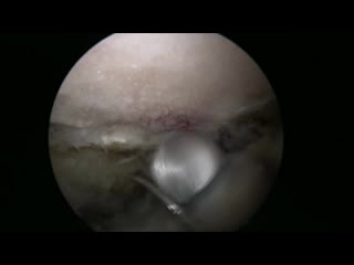 Hip arthroscopy surgery capsular preservation