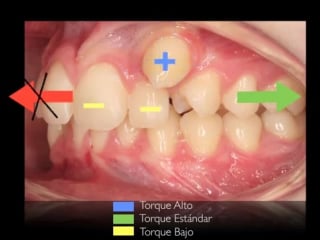 Tratamiento de un canino vestibular impactado colmillo alto ортодонтия