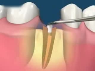 Лечение каналов и устаноа культевой ладки с коронкой