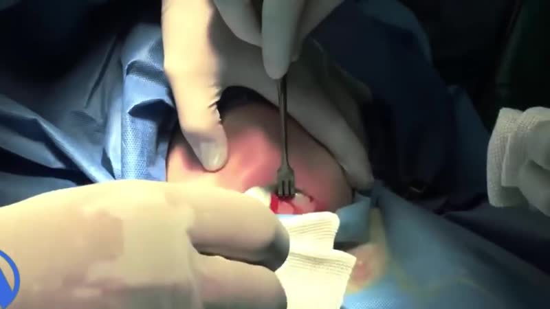 Вскрытие и дренирование подчелюстной флегмоны стоматология члх