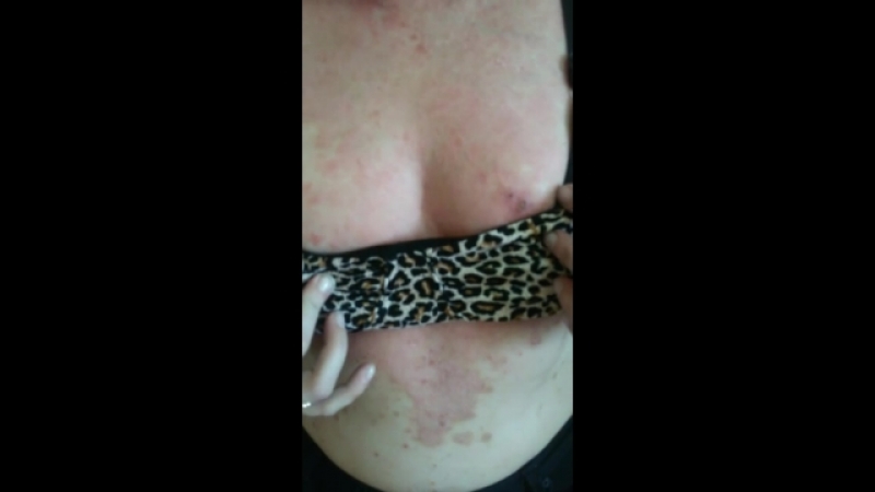 Псориаз улучшение