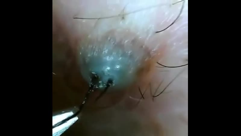 😫 вросший волос крупным планом