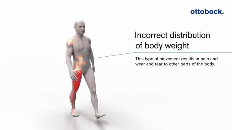 How the c brace® leg orthosis works ottobock