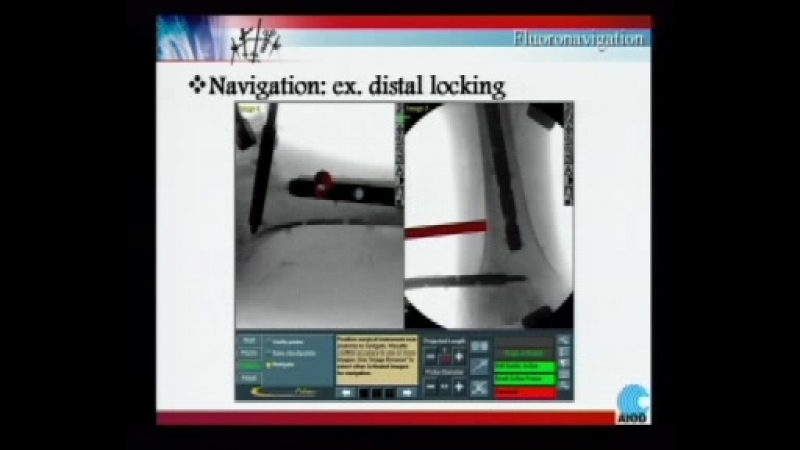 Doctor taglang france distal targeting device for femur and tibia nails prague mar 2004