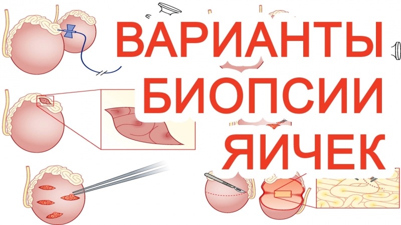 Яичек porn video – Варианты биопсии яичек