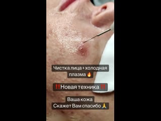 Видео от холодная плазма воронеж