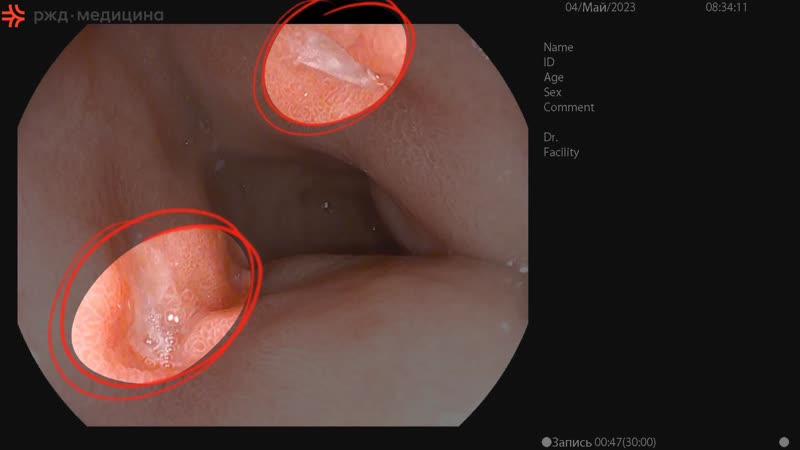Фиброгастродуоденоскопия (фгдс, гастроскопия)