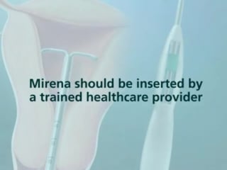 Mirena insertion and placement