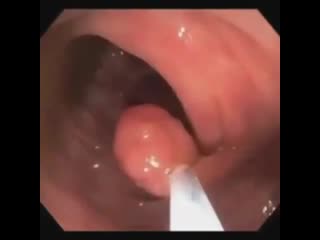 Удаление полипа толстой кишки!