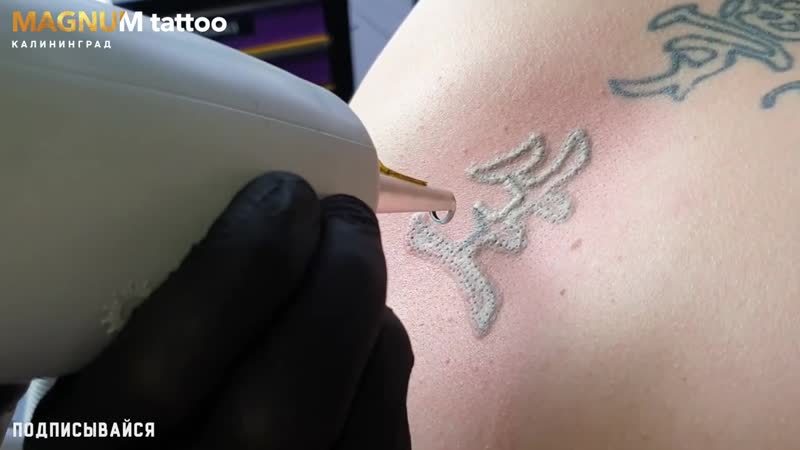 Лазерное удаление татуировок калининград magnum tattoo