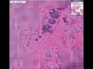 Bone, vertebrae osteomyelitis and chondritis