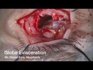 Globe evisceration with implant