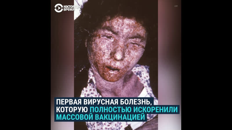 Как массовая вакцинация победила оспу, от которой умирали сотни миллионов людей