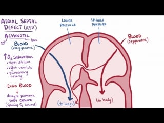 Atrial septal defect (asd)