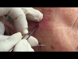 Удаление маленькой кисты на лице