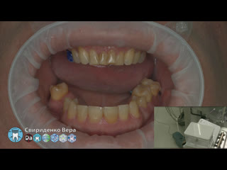 Professional oral hygiene dte pt 5 acteon kerr hawe dentsply (fhd multistream)