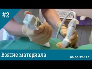 Трепан биопсия опухоли молочной железы под контролем узи