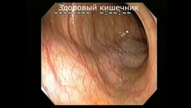 Колоноскопия кишечника под наркозом (процедура) очищение организма от шлаков и токсинов в домашних условиях (отзывы, цена)