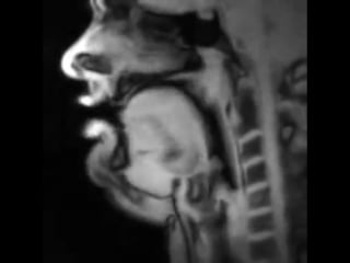 Мрт головы во время пения