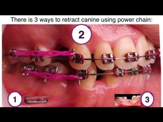 Canince traction by power chain in orthodontics by dr amr asker ортодонтия