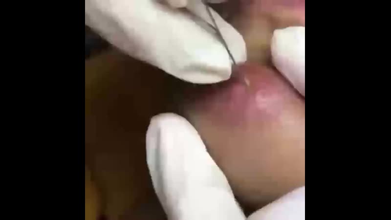 Гной чистка кожи прыщи акне мерзко жесть (720p) mp4