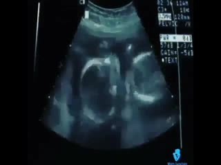 Сосательный рефлекс