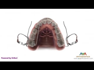 Expander quad helix type orthodontic device пропедевтика ортодонтии