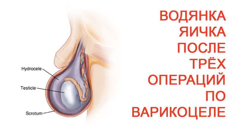 Водянка яичка после трех операций по варикоцеле