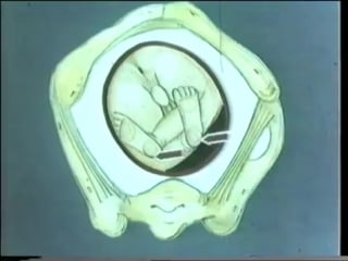 Роды при тазовом предлежании плода © breech presentation of the fetus