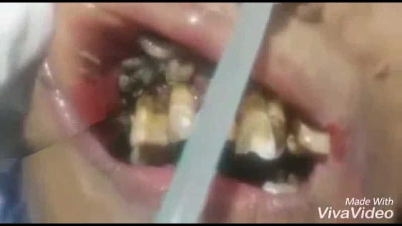 Зубки