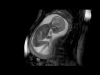 Mri during pregnancy