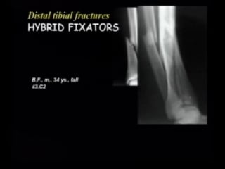 Doctor varsalona italy peri articular fractures using hybrid fixation prague mar 2004