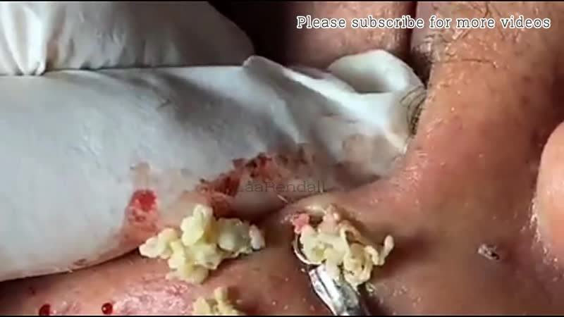 Очень содержательные подкожные угри