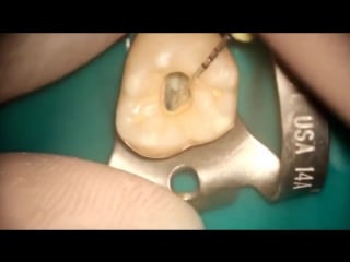 Second maxillary molar endodontic acces cavity