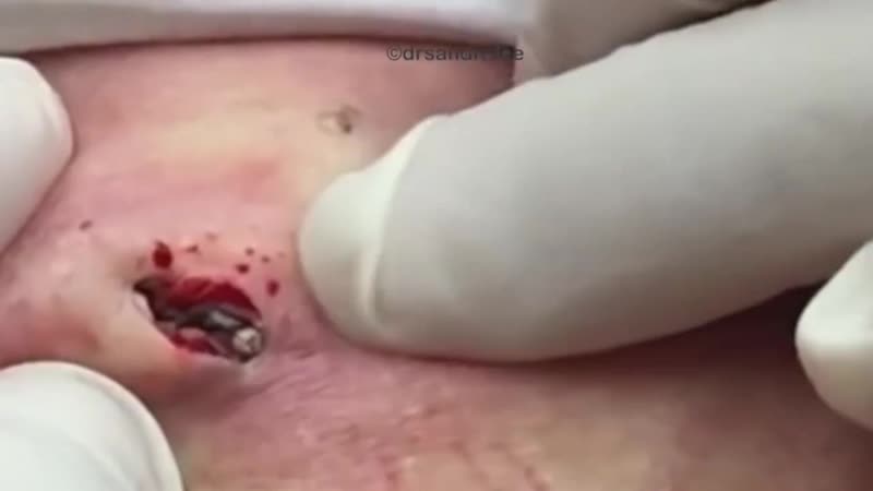 Расширенные поры винера или "черные точки"