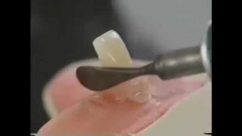 Полное съемное протезирование постаноа в артикуляторе