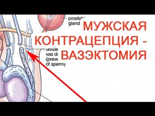 Мужская контрацепция – вазэктомия