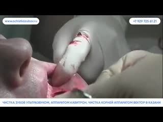 Ochistkazubov ru – комплексная профессиональная чистка зубов в казани